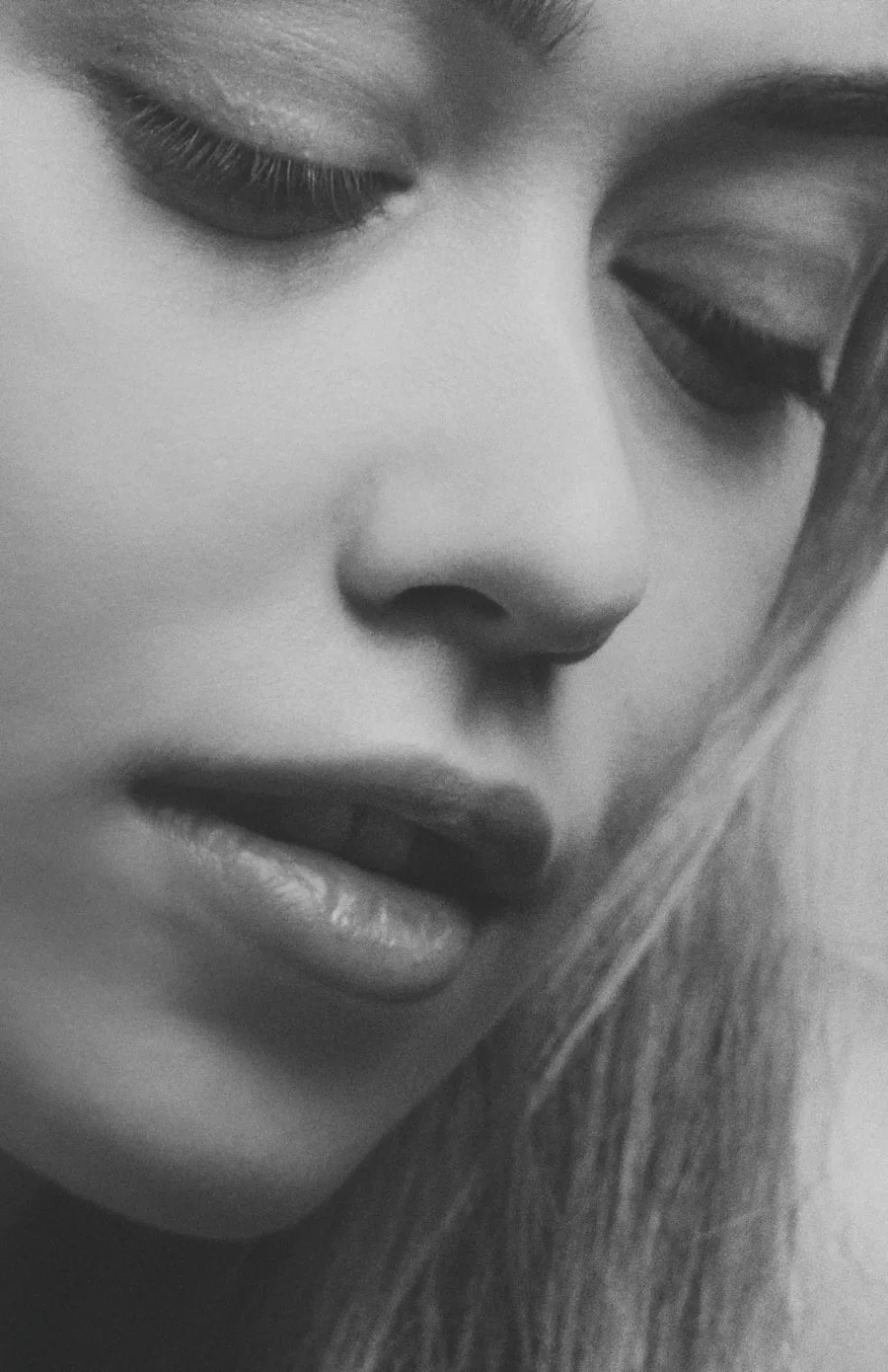 Depois — Toxina Botulínica — Testa e Glabela