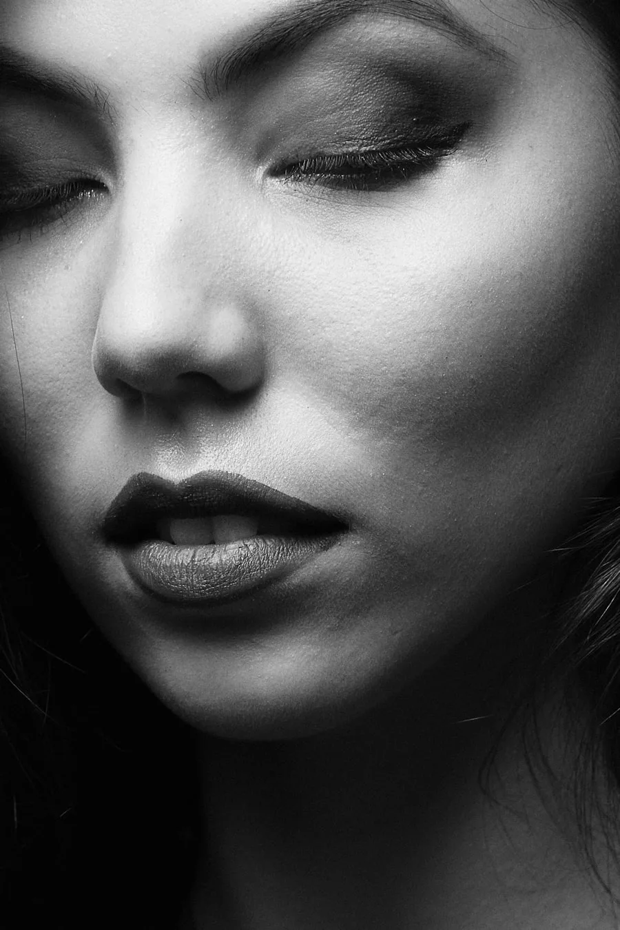 Depois — Preenchimento Labial