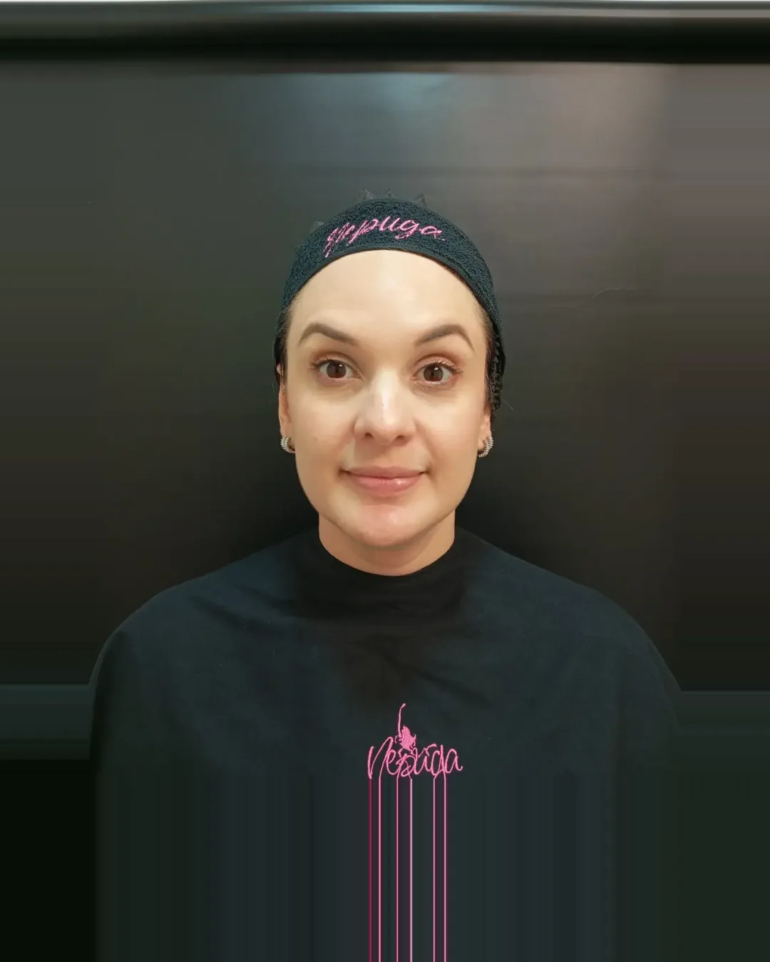 Depois — Toxina Botulínica — Testa